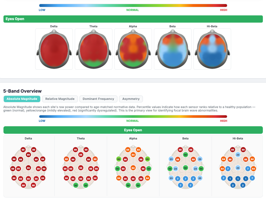 QEEG brain mapping dashboard analysis view
